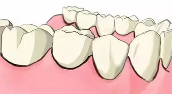 种牙和镶牙哪个更优秀 扬州牙科专家用几张图片就说清楚了